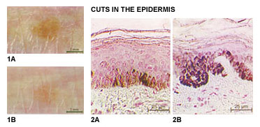 1A, 1B, Cuts in the Epidermice: 2A, 2B